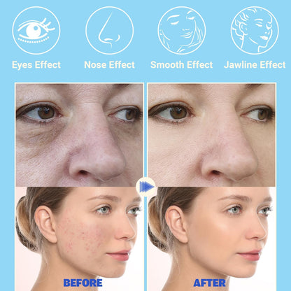 Radio Frequency Neon + Argon - Remove Wrinkles, Inflammation, Acne, Pores by stimulating the production of new collagen and elastin and help to grow hairs