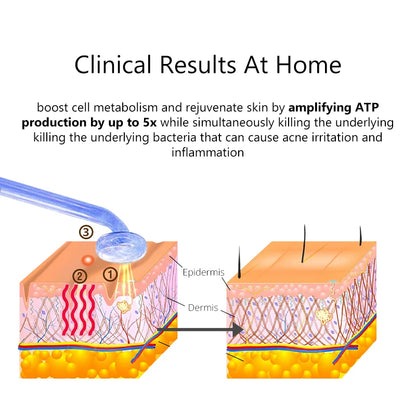 Radio Frequency Neon + Argon - Remove Wrinkles, Inflammation, Acne, Pores by stimulating the production of new collagen and elastin and help to grow hairs
